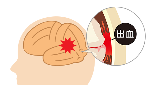 くも膜下出血の治療：イメージ画像