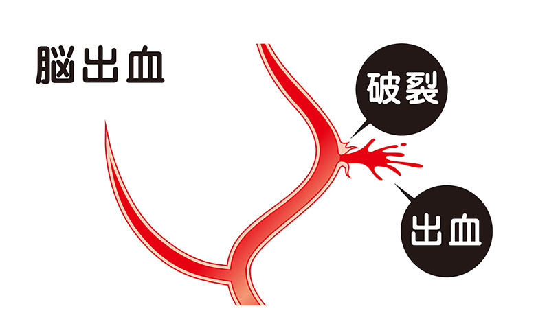 脳出血(脳内出血)とは:イメージ画像
