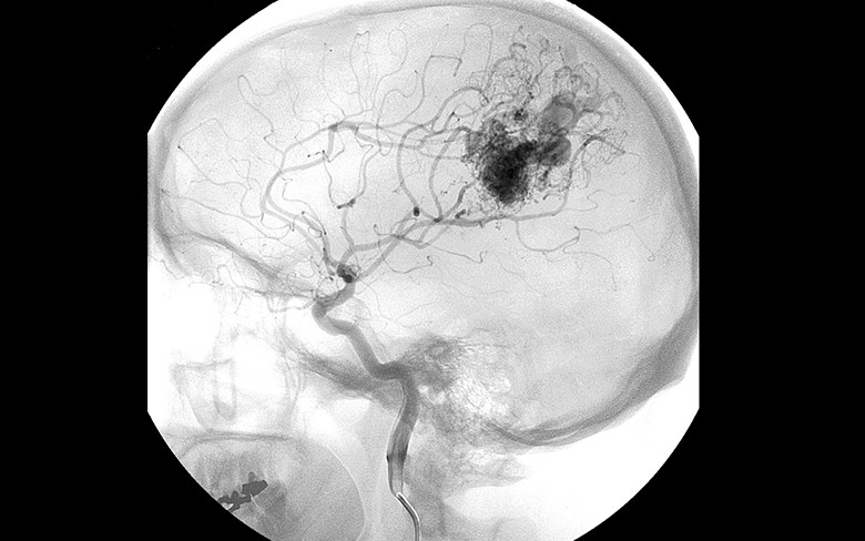 脳動静脈奇形:イメージ画像