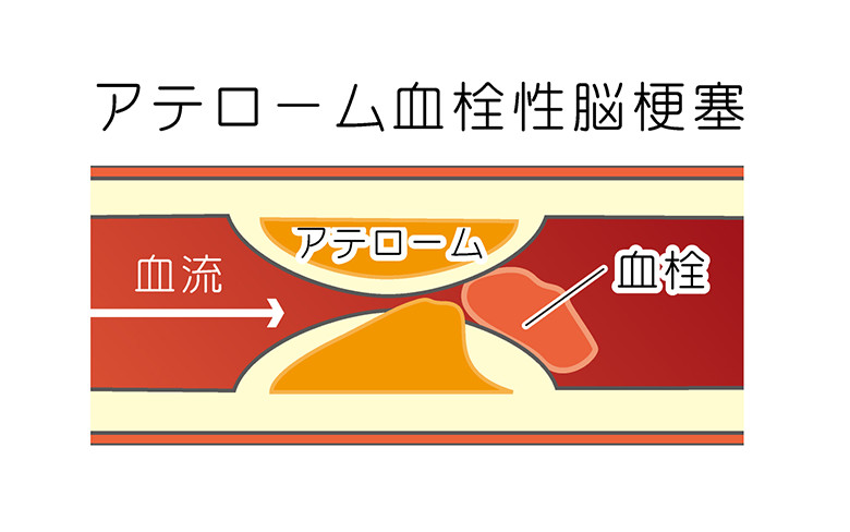 アテローム血栓性脳梗塞:イメージ画像