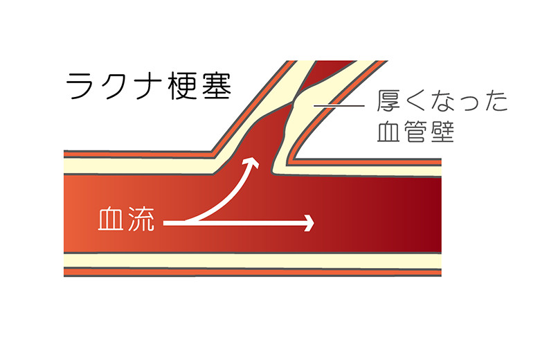 ラクナ梗塞:イメージ画像