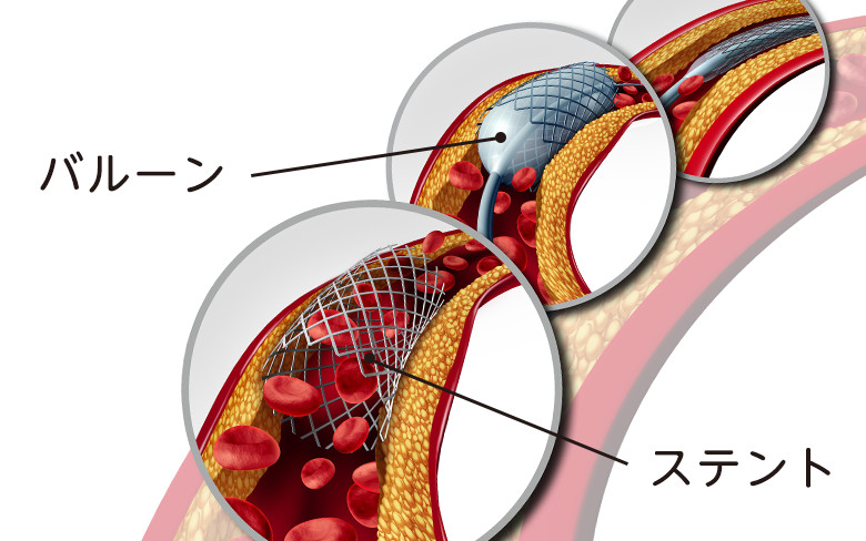 心筋梗塞の治療のための定期的検診のすすめ:イメージ画像