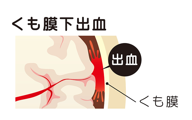 出血 何 意識 日 下 くも膜 不明 【医師監修】くも膜下出血で意識不明になることもある？その場合、手術できる？