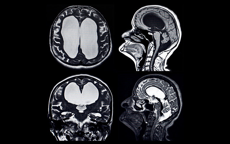 水頭症(すいとうしょう):イメージ画像