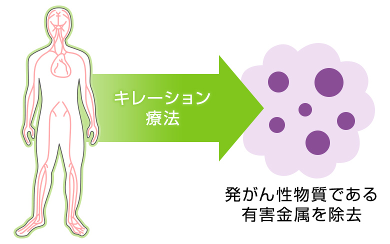 キレーション療法で発がん性物質である有害金属を除去